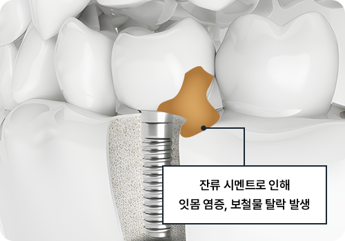 임플란트 시멘트 잔류 이미지